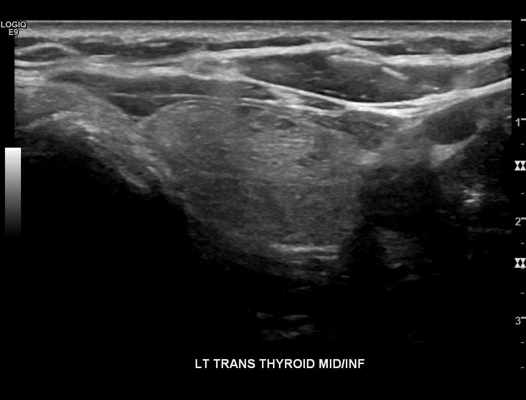 Thyroid Detection