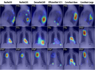 Loss Design for Long Tail CXR Classification paper thumbnail